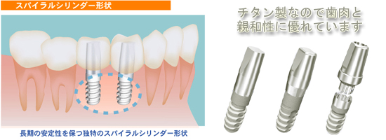 インプラント治療について